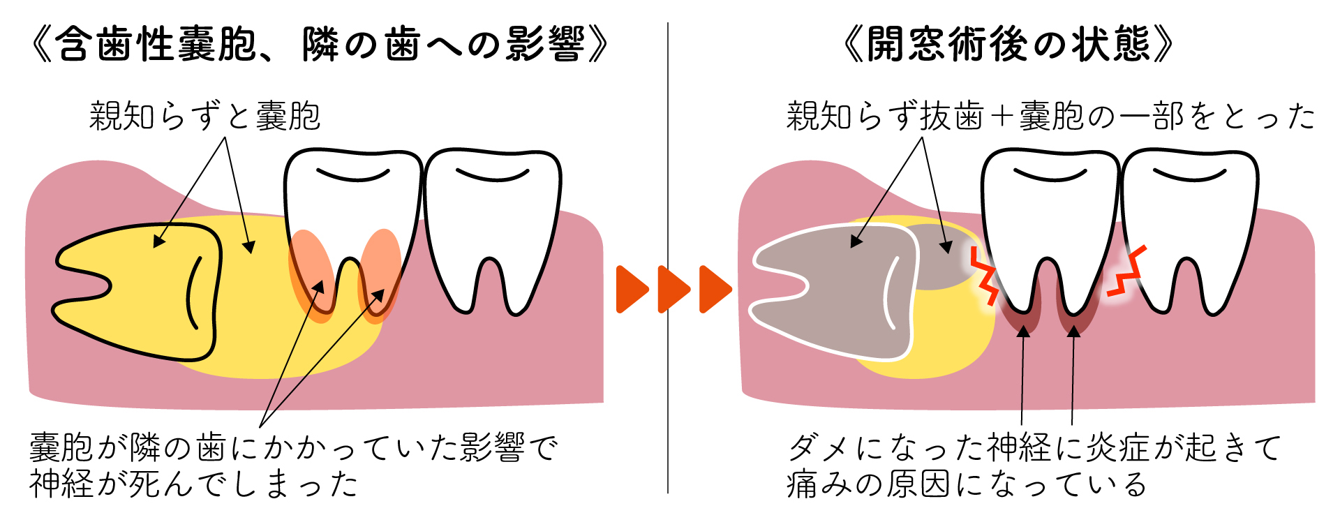 嚢胞の形成を防ぐことはできますか?